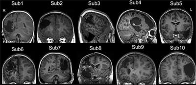 Alterations in Spontaneous Brain Activity and Functional Network Reorganization following Surgery in Children with Medically Refractory Epilepsy: A Resting-State Functional Magnetic Resonance Imaging Study